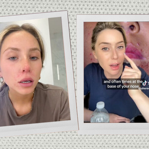 woman like perioral dermatisis (red rash / spots) on face