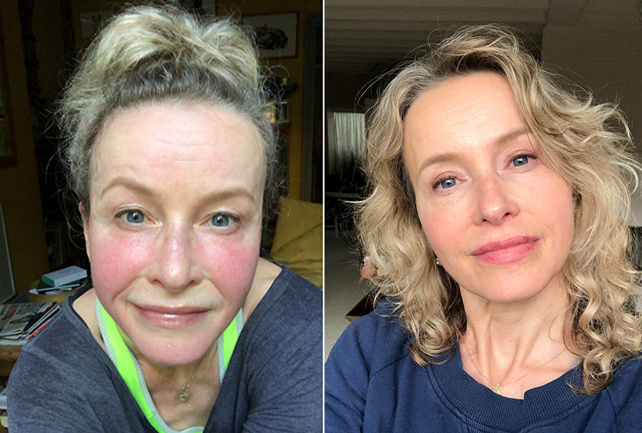 Inge (left) before treatment after exercising and (right) after the treatment