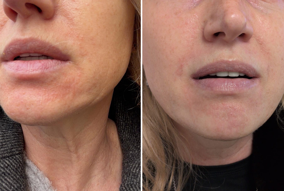 Perioral dermatitis 