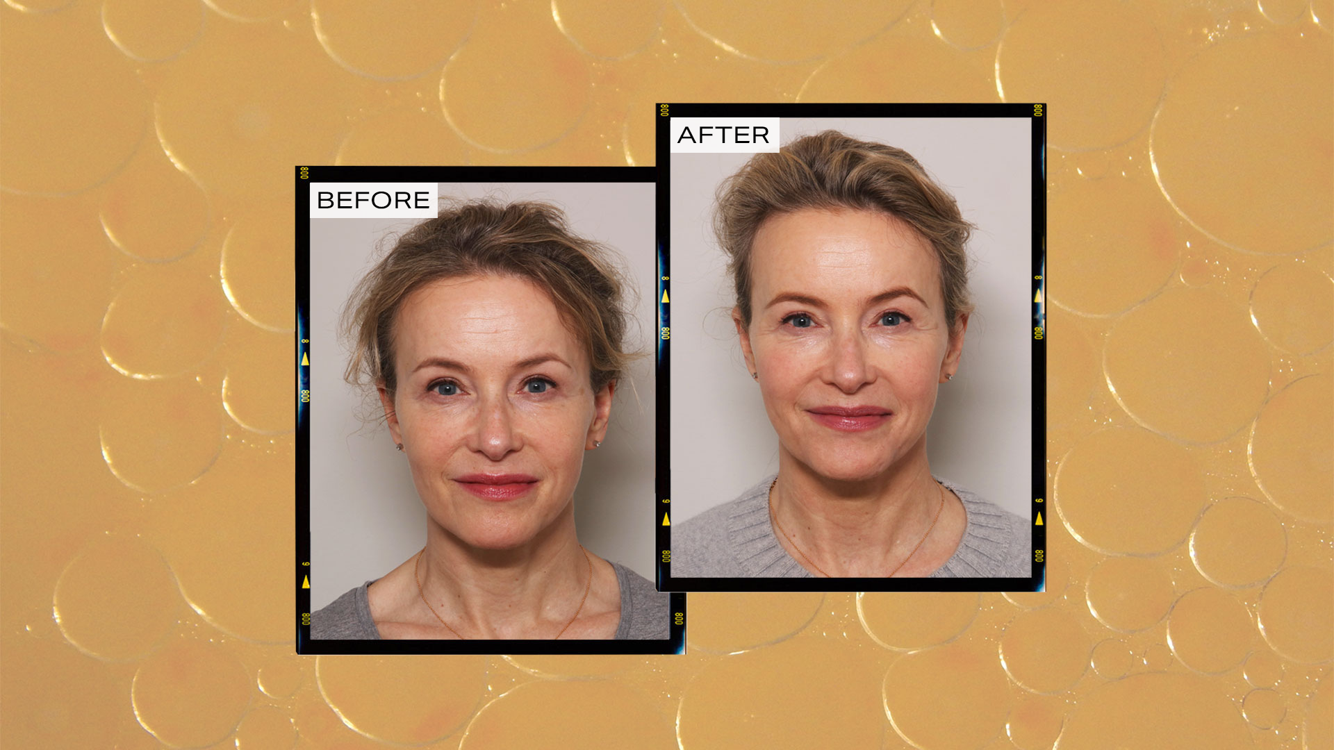 Julaine is the injectable ‘face filter’ everyone’s talking about – and ...